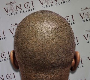 Baldness Solution With Tattoos