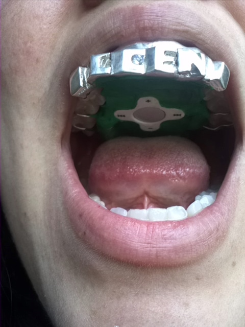 Tongue Controlled Mp3 Player Now Available Tongue Controlled Mp3 Player Now Available