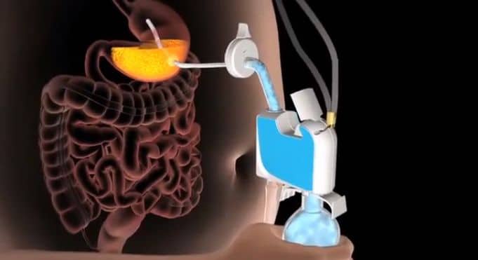 That’s One Way To Do It…Home Stomach Pumping Weight Loss Device That’s One Way To Do It…Home Stomach Pumping Weight Loss Device