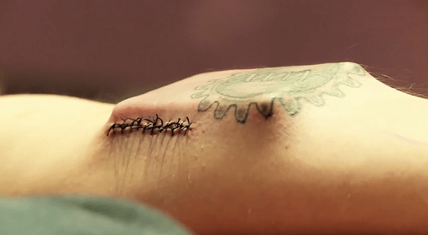 Guy Becomes Bionic By Inserting A Computer Into His Arm Himself